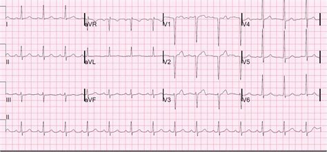 Dr. Smith's ECG Blog: Reversible T-wave inversion -- it reverses, then ...