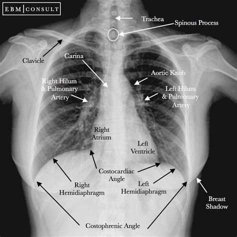 Neat How To Report Normal Chest X Ray Write A Good Introduction For Research