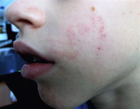 Cutaneous larva migrans in a temperate area | Archives of Disease in Childhood