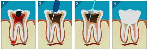 RCT-Root-canal | Jerush Dental and Facial Corrective Centre