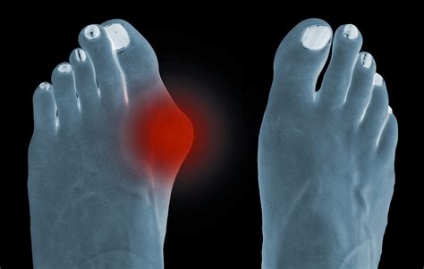 Ganglion Cyst in the Big Toe Joint [Causes, Symptoms & Best Treatment!]