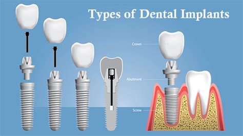 WHAT ARE THE MAJOR TYPES OF DENTAL IMPLANTS AVAILABLE?