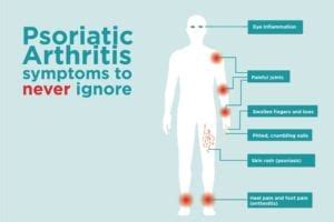 Psoriatic Arthritis Signs and Symptoms