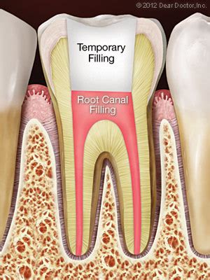 Root Canal Treatment | Beattie Family Dental | Davenport IA