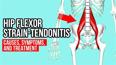 What Causes Hip Flexor Pain - Cares Healthy