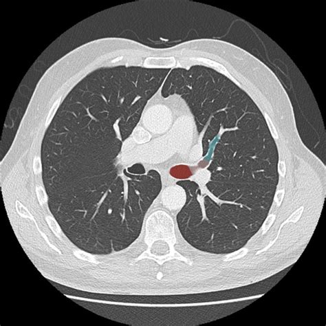 Anatomy Of Chest Ct Scan Automatic Interpretation Of Chest Ct Scans ...