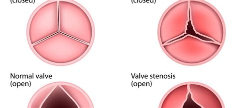 A heart murmur? Causes and symptoms of heart murmurs – Healthy Food Near Me