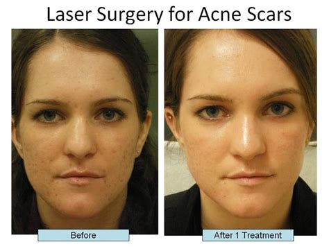 Laser Treatments For Acne Scars | Schweiger Dermatology Group