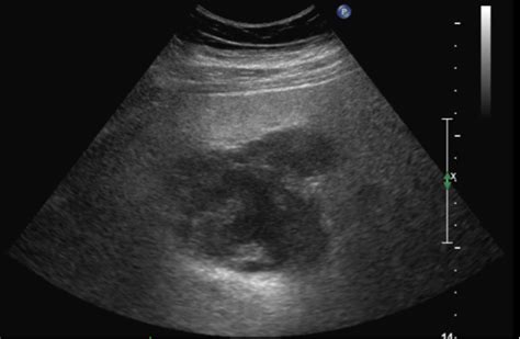 Pulmonary Hamartoma | Consultant360