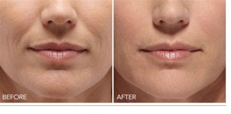 Everything you need to know about wrinkle fillers