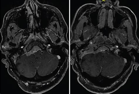 Foramen magnum/petroclival meningioma – immediate postoperative radiosurgery for residual ...