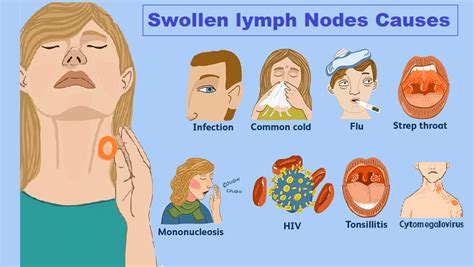 What Would Cause Swollen Lymph Nodes In Your Neck - Infoupdate.org