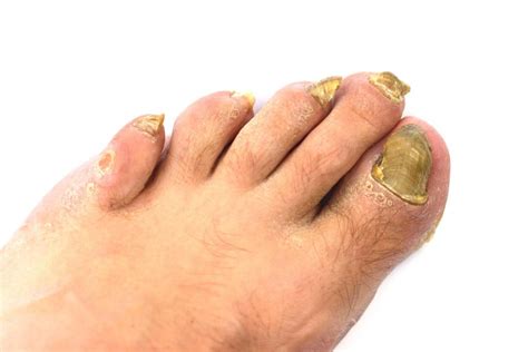 9 Natural Ways to Treat Toenail Fungus at Home – Onychomycosis Help