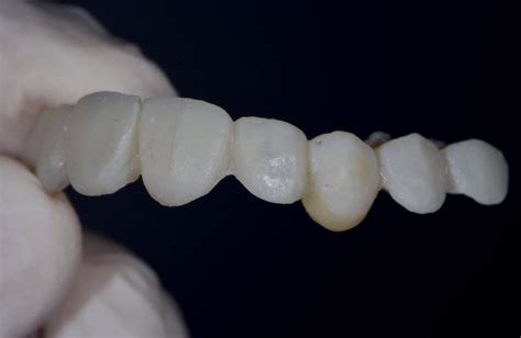 Dental Esthetics: Ovate pontic for the correct emergence profile.. A clinical case