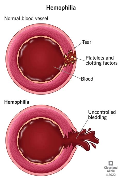 Haemophilia- Introduction, Types, Pathophysiology, Diagnostics ...