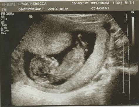 12 week sonogram - tacticalkesil