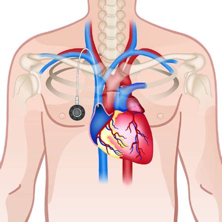 Chemoport Insertion | Varicose veins | Vascular surgeon | Stroke | DVT | Leg gangrene | Cancer