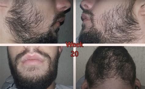 Minoxidil Beard Growth: Before & After, Usage, Side Effects