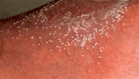 White Spots on Legs, Dry Spots, Itchy, Blood Circulation, Thighs ...