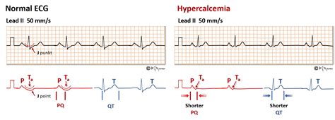 Hypercalcemia Ecg