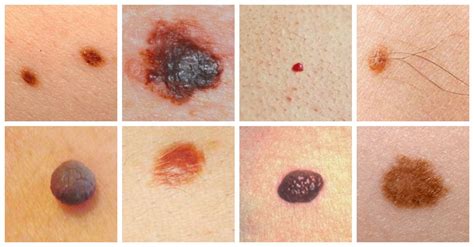 Skin Cancer - Causes, Symptoms and Treatment | Health Care "Qsota ...