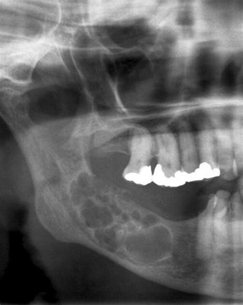 Ameloblastoma X Ray