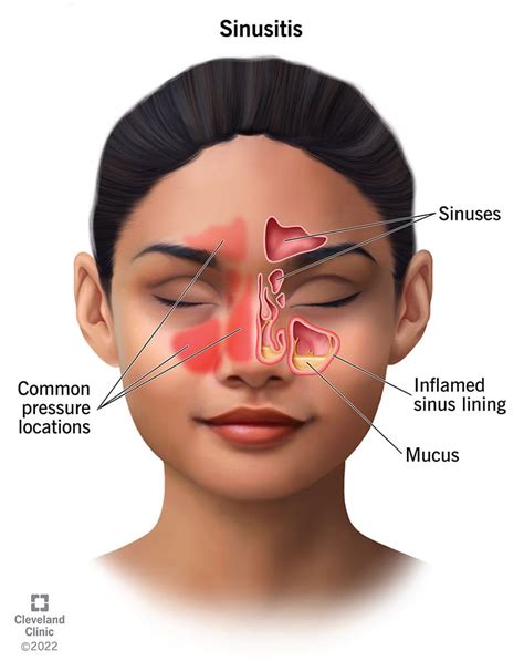 Sinus Infection (Sinusitis): Causes, Symptoms Treatment | atelier-yuwa ...