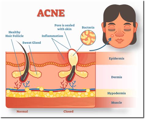 Acne - everythingherbs