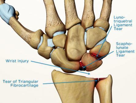 Scapholunate ligament injury - Melbourne Hand Surgery