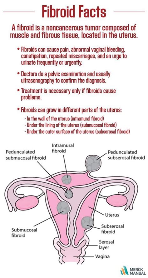 By age 45, about 7 out of 10 women develop fibroids of the uterus ...