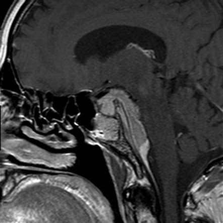 Petroclival meningioma | Radiology Case | Radiopaedia.org