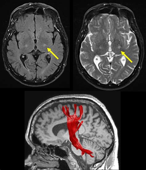 Corticospinal Tract Diseases