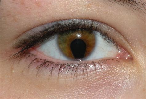 File:Coloboma of the iris.JPG - Wikimedia Commons