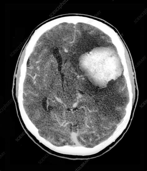 Cat Scan Brain Tumor