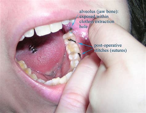 Dry socket after wisdom tooth extraction | Ear, Nose, Throat, and ...