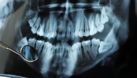 impacted-wisdom-tooth-xray – The Facial & Oral Surgery Center