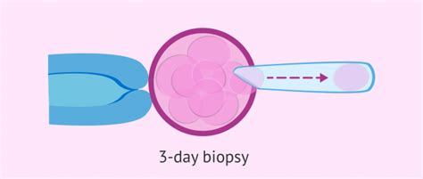 Blastomere biopsy on day 3