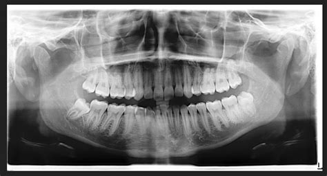 Normal Wisdom Teeth X Ray