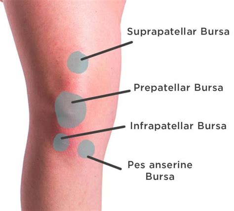 knee-bursitis-skin-pic - Back in Action