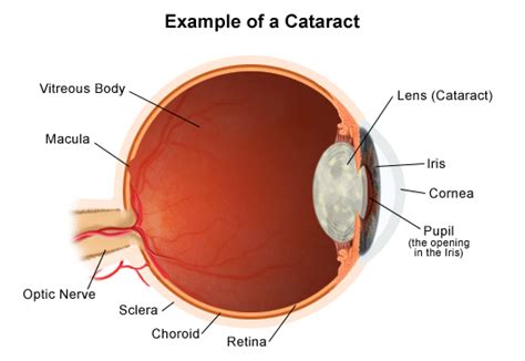 Eye Cataract Without