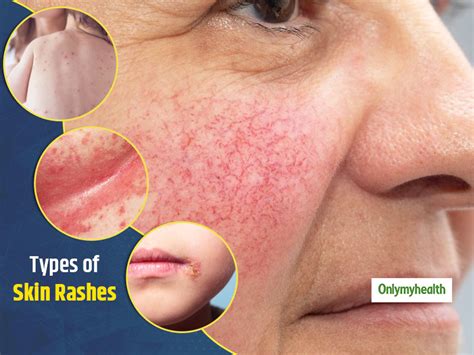 A Dermatologist's Guide To 7 Types of Skin Rashes | OnlyMyHealth