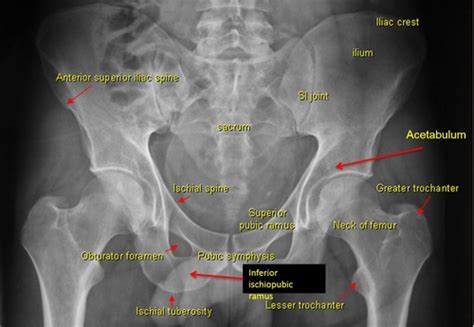 Pelvis and hip joint pathology Flashcards | Quizlet