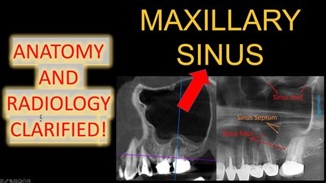 ALL Maxillary Sinus Anatomy 3D CBCT Mucosal Thickening in x ray OPG ...