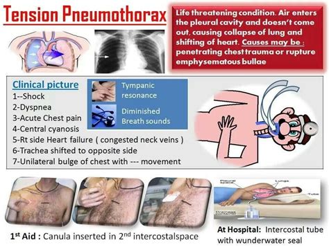 #Tension #Pneumothorax Nursing Mnemonics, Icu Nursing, Nursing Study ...