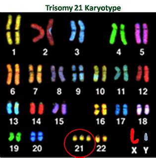 Aneuploidy: Definition & Disorders | Study.com