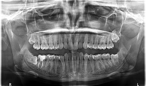 SAMPLE OPG XRAY - Caring 4 Smiles