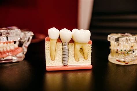 Dental Restoration Types: Direct vs. Indirect