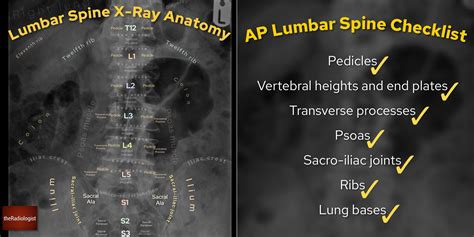 Lumbar Vertebrae Anatomy Xray