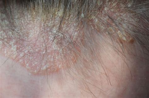 Scalp Psoriasis: What Dermatologists Wish You Knew | Reader's Digest