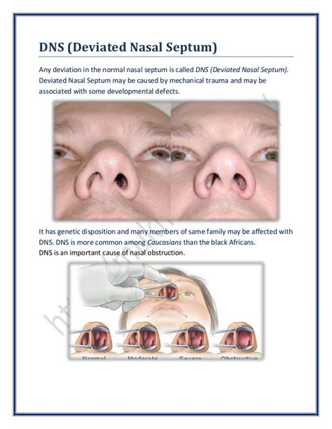 Dns (Deviated Nasal Septum) | SurgicoMed.com